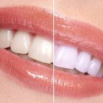 teeth whitening before/after